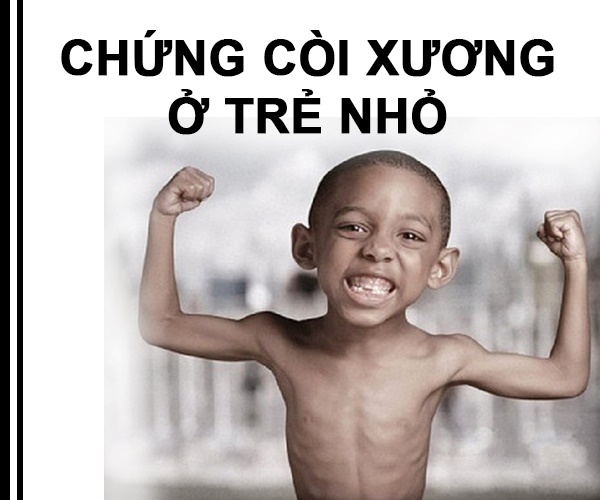 Còi xương - Hình ảnh minh họa
